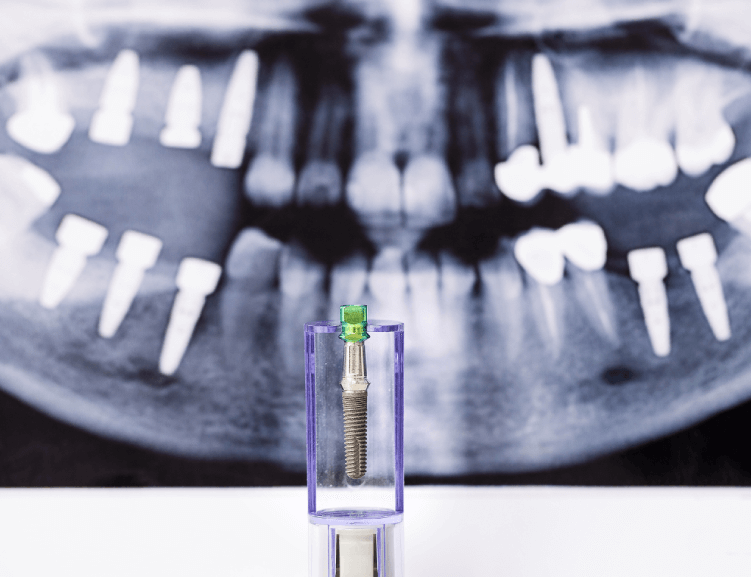 Benefits of Dental Implants in Usak