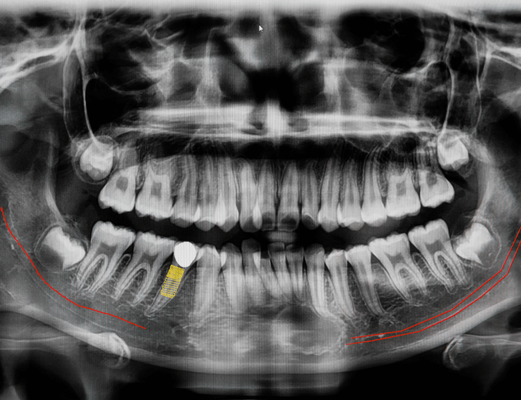Advanced Jaw Surgery Techniques