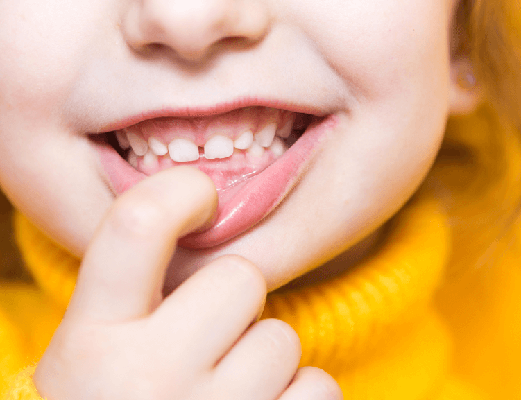 Pediatric Dentistry at Diva Dental Clinic