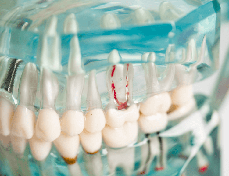 Advanced Root Canal Techniques