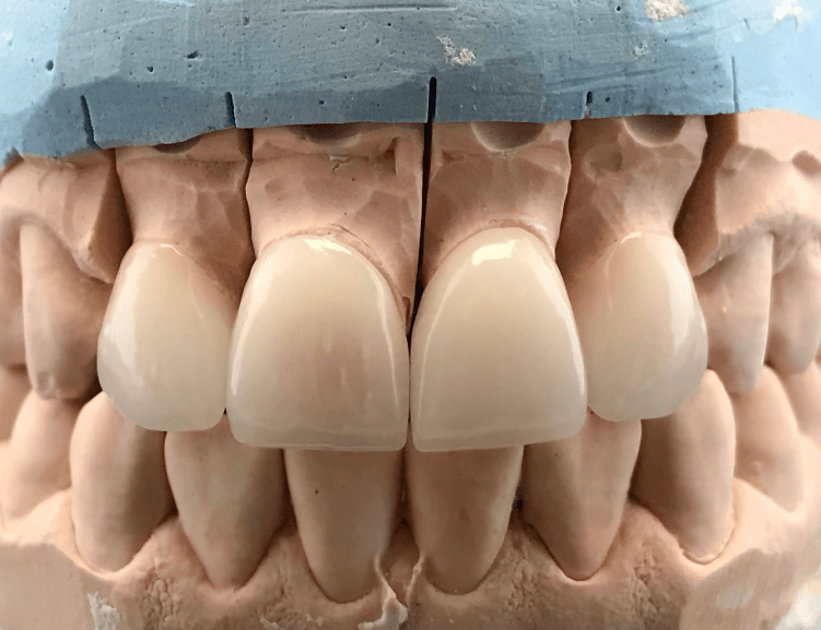 Zirconium Coating at Diva Dental Clinic